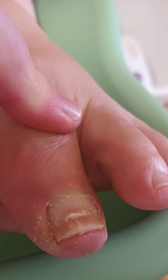 Fungal Nail Fungal nail of the big toenail