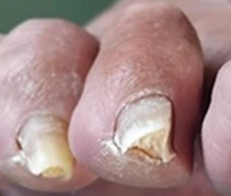 Thickened nail Thickened nail