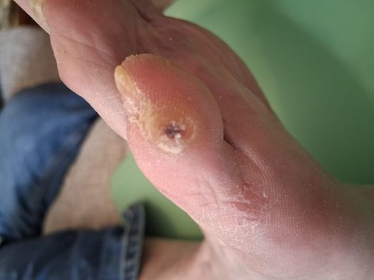 Extravasation leading to an ulcer Extravasation leading to an ulcer