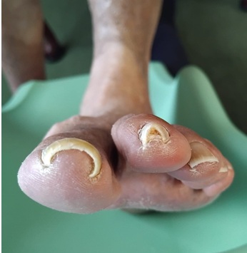 Involuted nails Involuted curling Nails