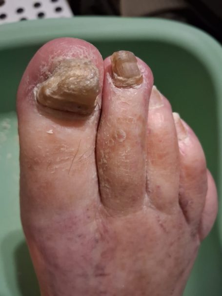 Fungal Nail Fungal Nail