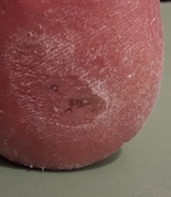 Multiple corns Multiple corns