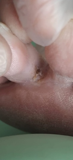 Athlete's Foot Athlete's Foot