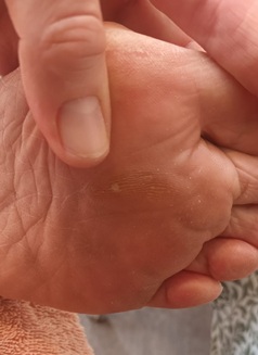 Corn Corn on sole of foot