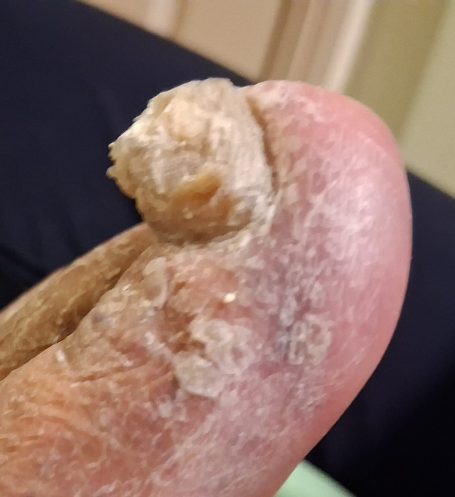 Fungal Nail Fungal Nail