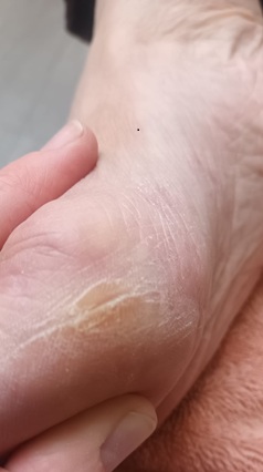 Callus Callus/ hard skin on side of foot