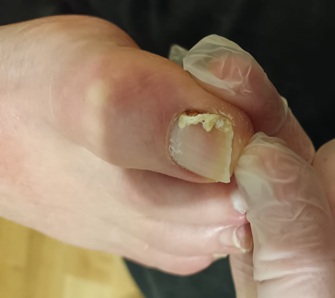 Fungal nail Fungal discolouration of toenail