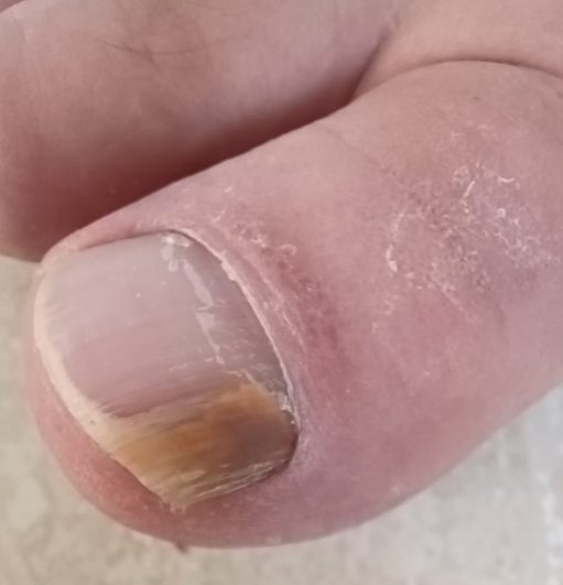 Fungal Nail