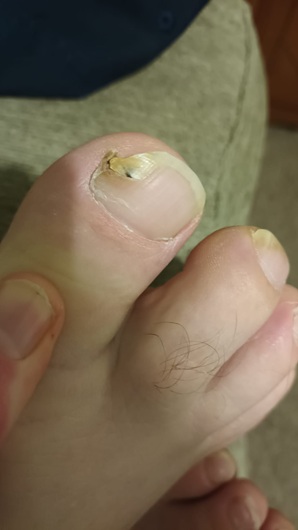 Fungal Nail Fungal Nail